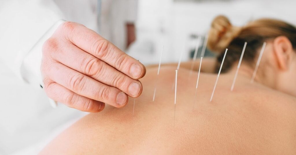acupuncture for fertility
